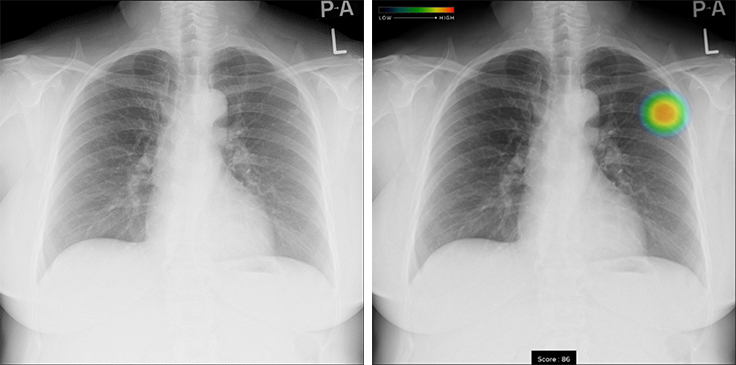 胸部X線画像病変検出ソフトウェア CXR-AIDの導入について