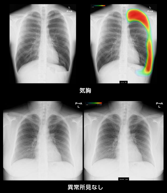 胸部X線AI解析│調布│内科│ひらいクリニック